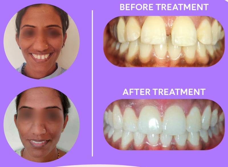 patient 1 overbite before and after braces result