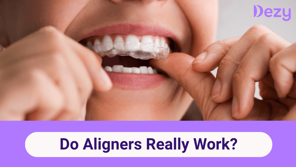 Do Aligners Really Work? Effectiveness & Results Explained