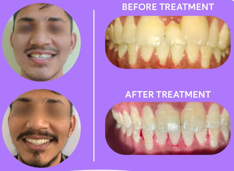 patient 2 - overbite with crowded teeth before and after braces result