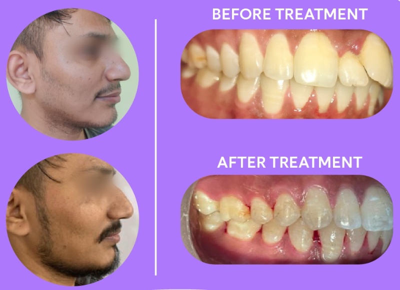 patient 2 - overbite with teeth crowding before and after braces result side view