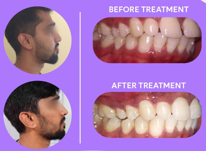 patient 3 - overbite with big front teeth gap before and after braces result side view