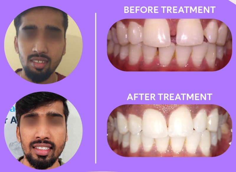 patient 3 - overbite with teeth gap before and after braces result