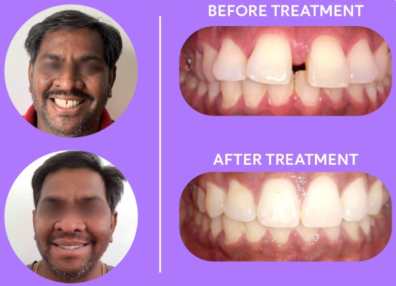 patient 4 - overbite with large front teeth gap before and after braces result