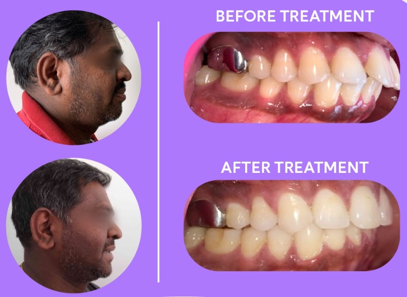 patient 4 - overbite with large front teeth gap before and after braces result side angle