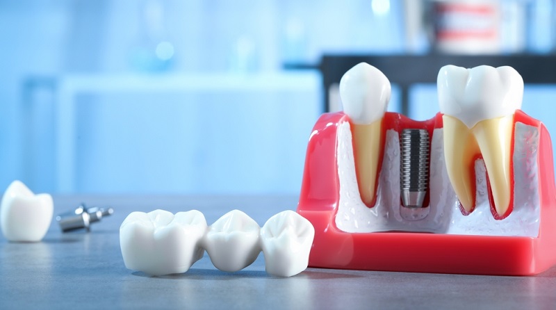 Top 6 Oral Health Benefits of Dental Bridges