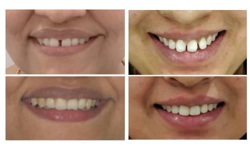dezy patients before and after clear aligners