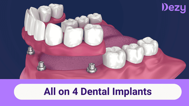 All on 4 Dental Implants