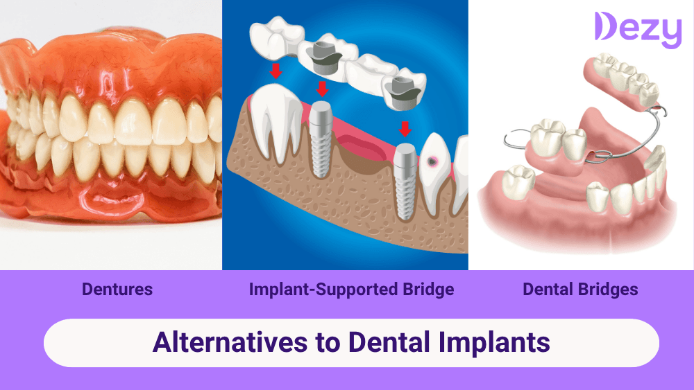 Alternatives to Dental Implants: Best Options to Consider in India