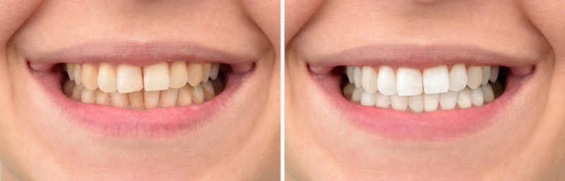 Baking Soda Teeth Whitening Before and After pictures