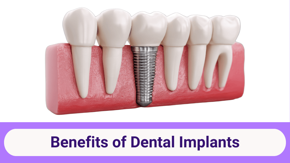 Benefits of Dental Implants