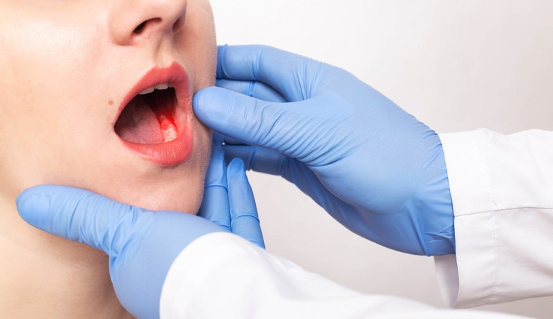 Bleeding Gums Cancer: Must Know Signs and Symptoms