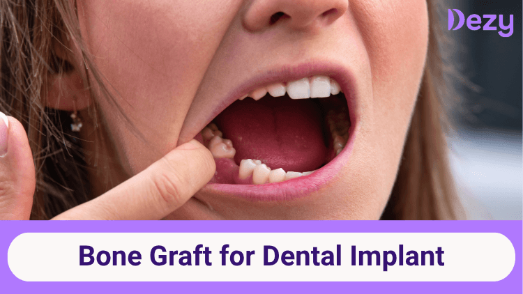 bone-graft-for-dental-implant-1774412611443.png