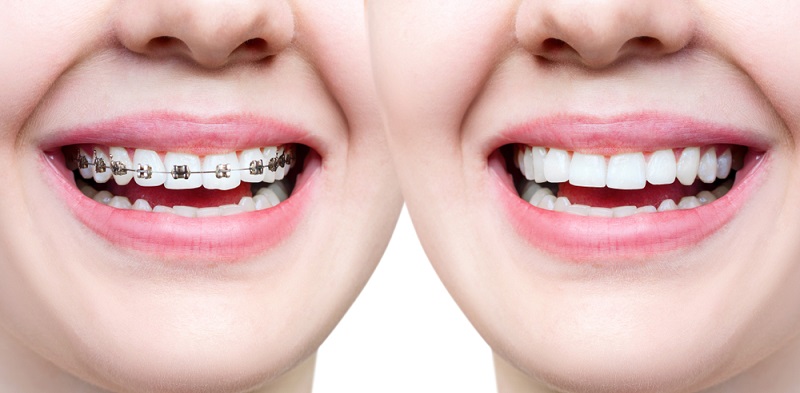 Orthodontic Treatment Results: Braces Before and After Images