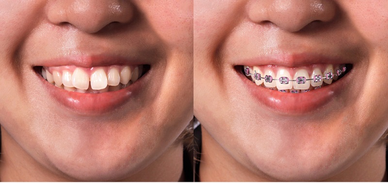 Dezy braces before and after treatment