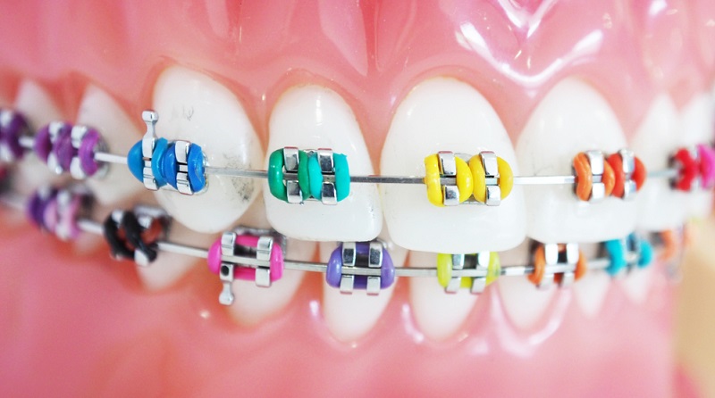 Everything You Need to Know About Braces Colors!