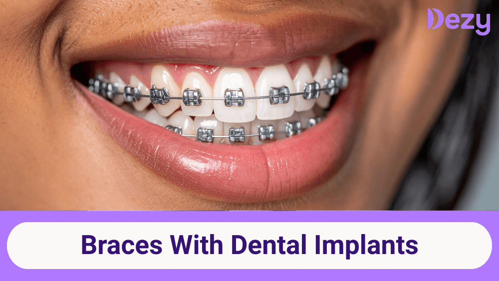 braces-with-dental-implants-1772789833350.png