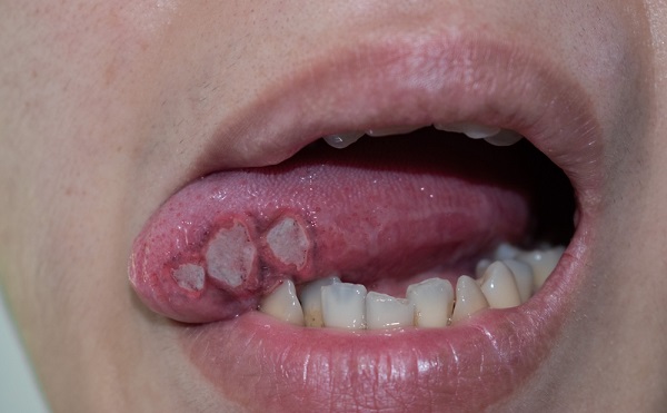 canker sore on the lips and tongue