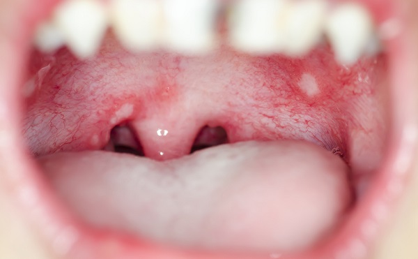 canker sore on the mouth