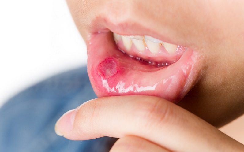 Canker (Mouth) Sores: Symptoms, Causes, Pictures and Treatment
