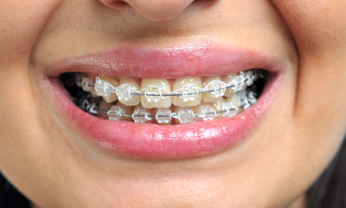 ceramic braces