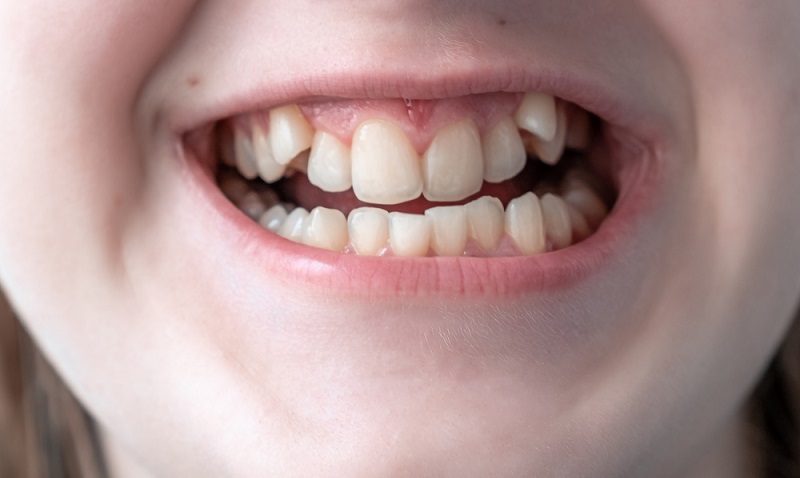 class 2 malocclusion causes types treatments
