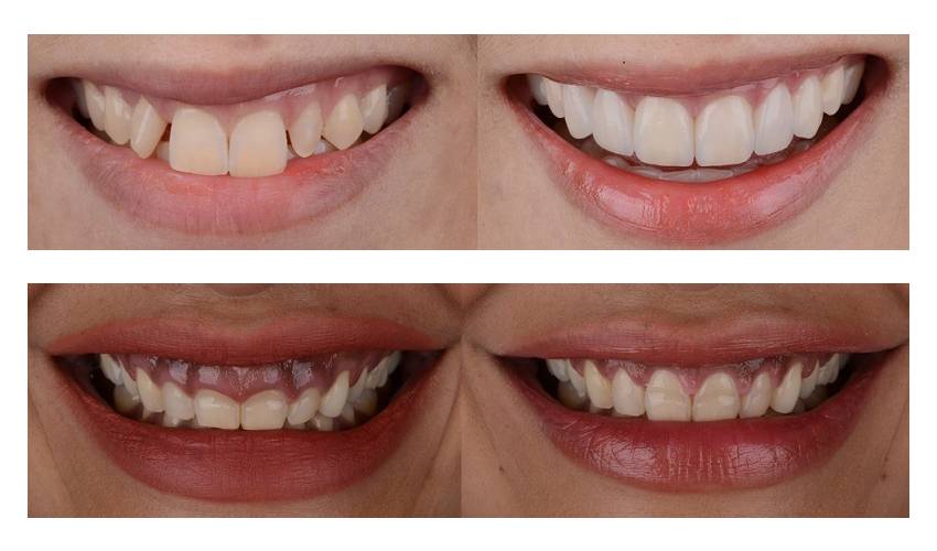 clear aligners before and after results image