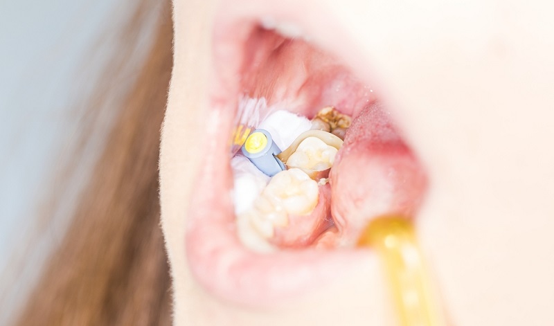 Composite Bonding Teeth: Procedure, Pros, Cons and More