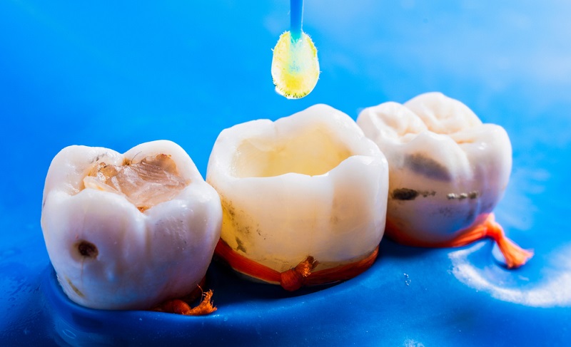 Composite Resin: Achieve a Natural, Radiant Smile with Ease