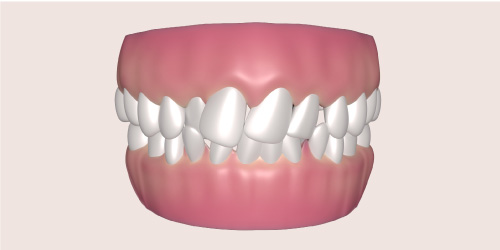 crowded or crooked teeth