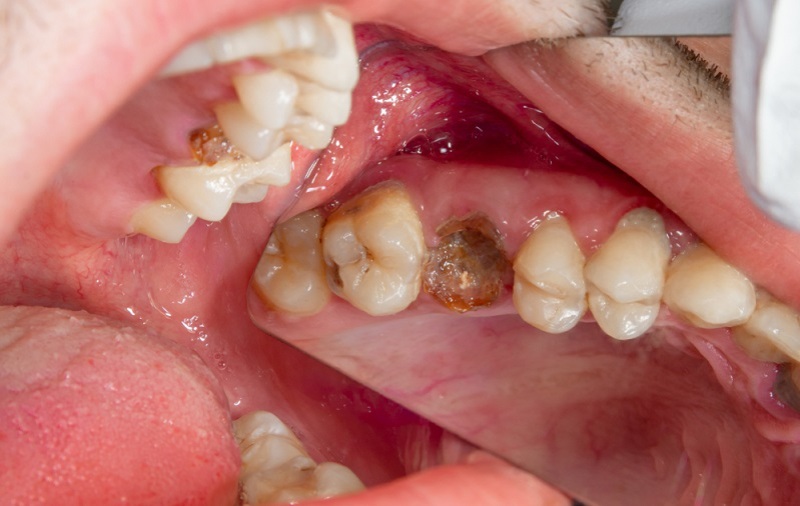 How Deep Cavities Can Impact Your Career Success & Well-Being