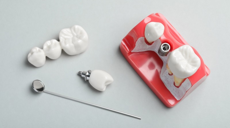 Dental Implant Abutments: Everything You Need to Know