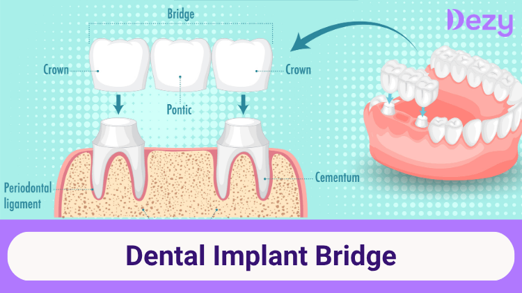 Dental Implant Bridge: Procedure, Benefits & Types Explained