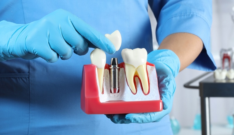 Bad Dental Implants: What Makes Dental Implants Fail?