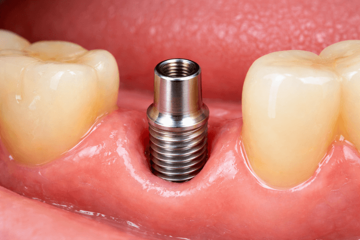 Dental Implant Post (Implant Fixture)