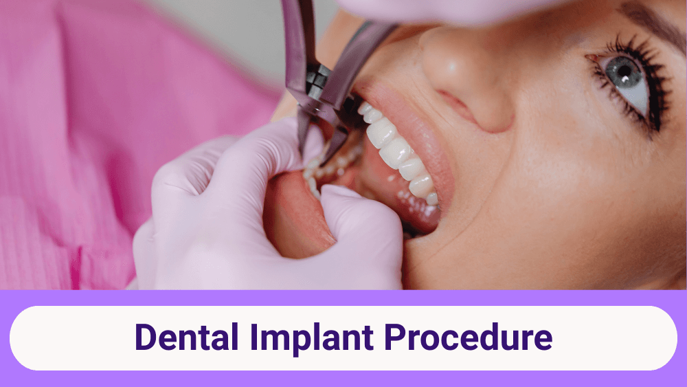 Dental Implant Procedure
