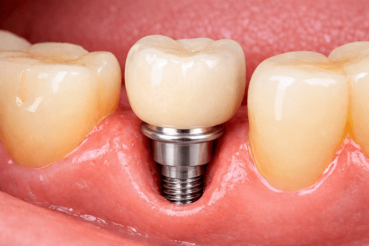 Dental Implant Prosthetics