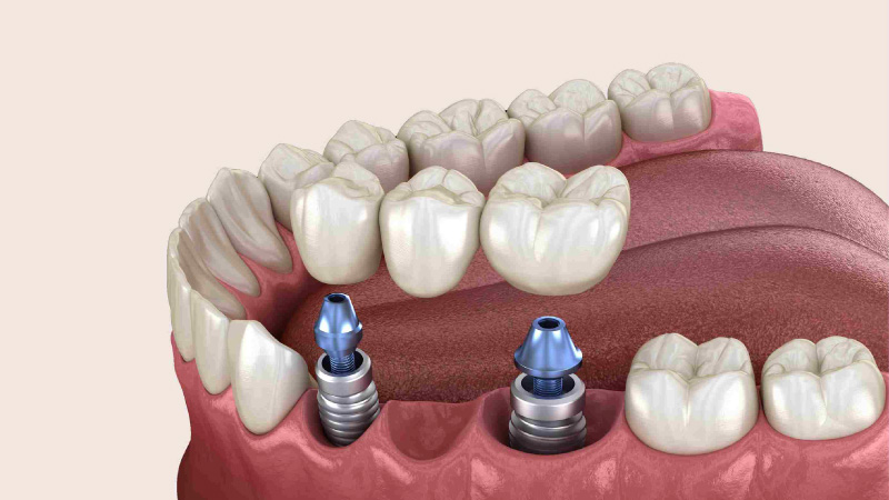 Step-by-Step Guide to the Dental Implant Procedure