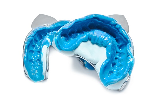 dental impression kit to close teeth gap