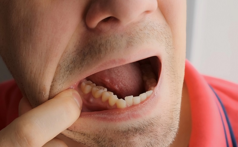 Dental Abscess: Key Symptoms, Treatment Options & Cost Breakdown