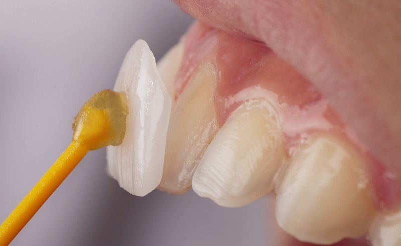 dental veneers process benefits