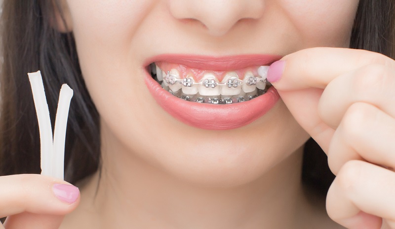 Dental Wax for Braces: How to Use & Apply for Braces