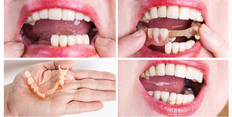 Dentures Before and After Stories That Will Amaze You!
