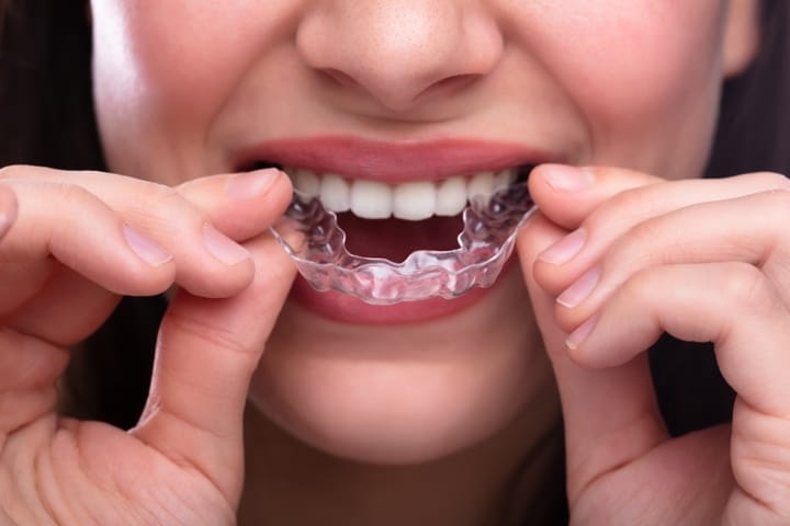 Dezy clear aligners