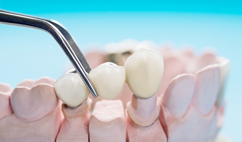 What Are The Different Types of Dental Bridges?