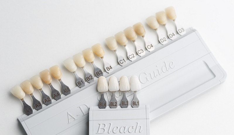 Different Types of Veneers: A Guide to Choosing the Right One