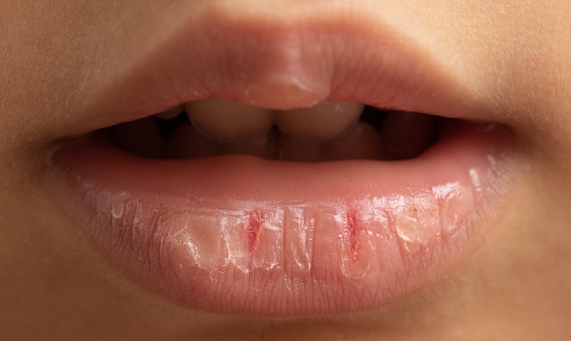 Dry Mouth at Night: How to Prevent Dry Mouth While Sleeping?