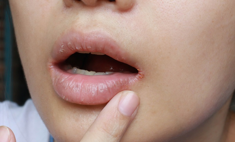 dry mouth symptoms and causes