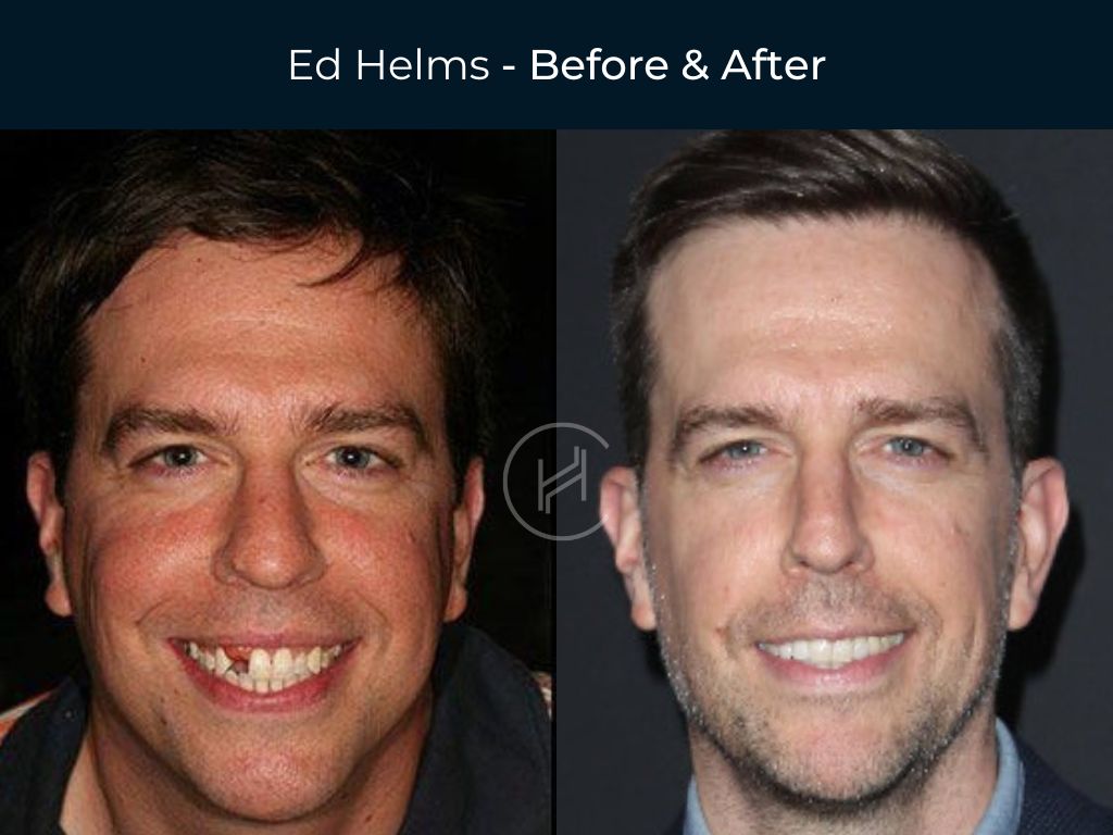 ed helms dental implants before and after