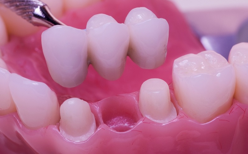 Front Dental Bridges: Your Key to a Flawless and Natural-Looking Smile