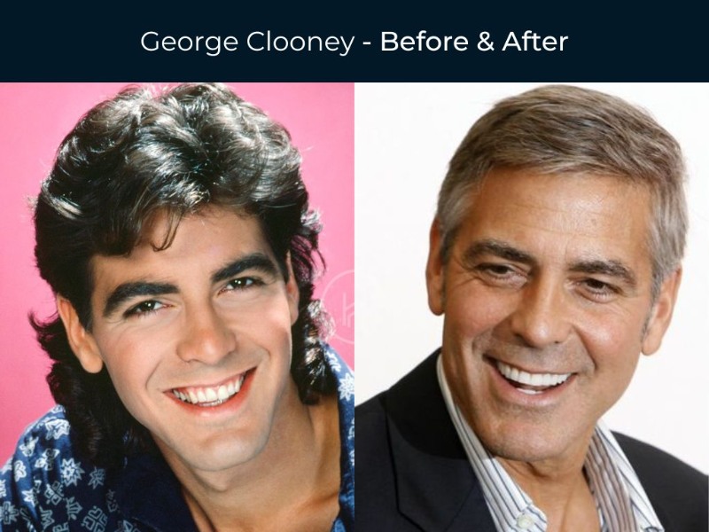 10 Celebrity Dental Implants Before And After Images!